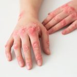 Waspadai Ciri-Ciri Penyakit Sifilis pada Wanita. Foto: viralsumsel.com