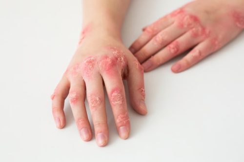 Waspadai Ciri-Ciri Penyakit Sifilis pada Wanita. Foto: viralsumsel.com